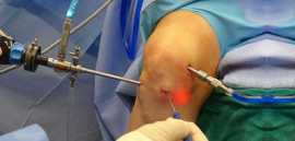 Expert in Arthroscopic Knee Surgery in Delhi, New Delhi