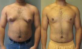 Gynecomastia surgery cost in Lahore, Lahore