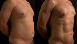 Liposuction in Lahore, Lahore