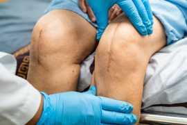 Best Knee Replacement Surgeon in Ahmedabad, Ahmedabad