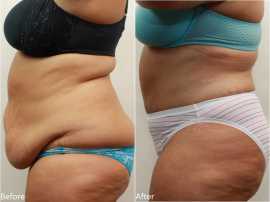 Tummy tuck cost in Lahore, Lahore