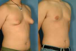 Gynecomastia surgery cost in Lahore, Lahore