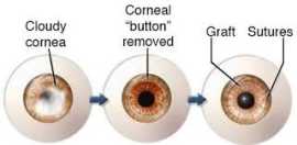 Corneal transplant, Geneva